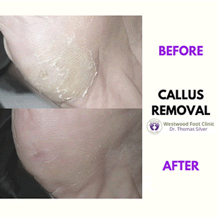callus before and after