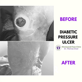 diabetic pressure ulcer