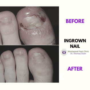 ingrown toenail3