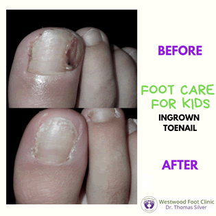 Ingrown Toenails Treatment  Foot Doctor Golden Valley, MN 55427