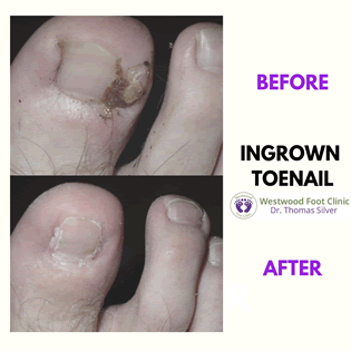 Ingrown Toenails Treatment  Foot Doctor Golden Valley, MN 55427