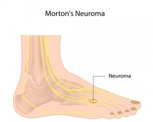 neuroma2