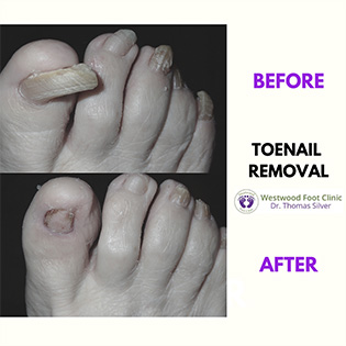 Deformed Toenails Treatment | Foot Doctor Golden Valley, MN 55427