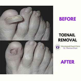 Toenail Removal1