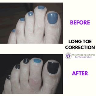 toe correction