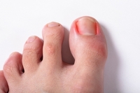 How to Know if You Have an Ingrown Toenail