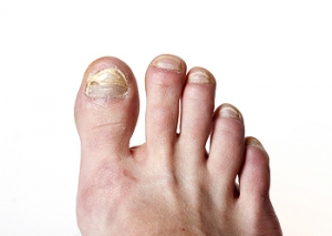 A Common Cause of Adult Acquired Flatfoot