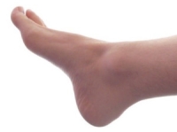 Plantar Hyperhidrosis May Increase the Risk of Other Foot Conditions