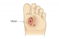 Treatment for Diabetic Foot Ulcers