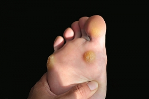 Living With Hammertoe