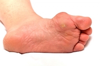 What is Athlete’s Foot?