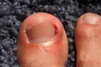 What Does Morton’s Neuroma Feel Like?
