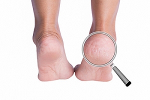 What Caused My Cracked Heels?