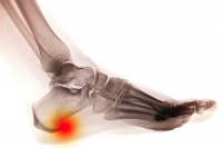Does Age Encourage the Formation of Heel Spurs?