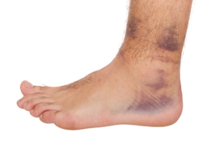 Difference Between Sprains and Strains