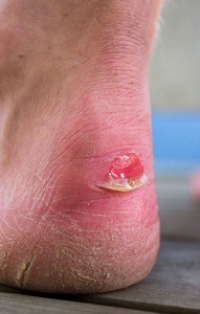How Can You Prevent a Blister From Forming?